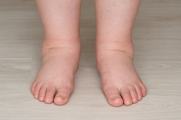 Отеки ног: причины, диагностика и значение своевременного лечения