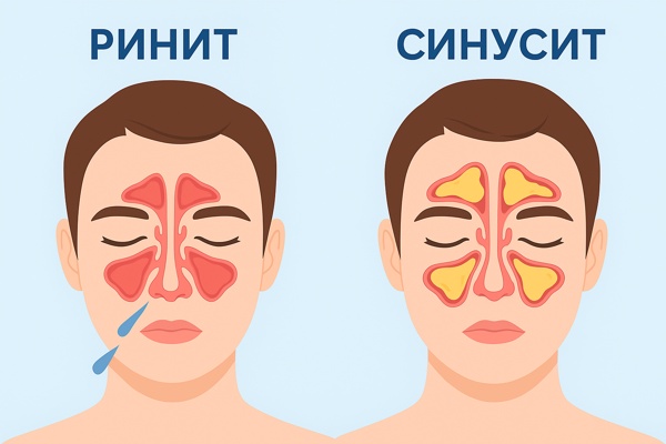 Ринит и синусит: в чем разница и как их отличить