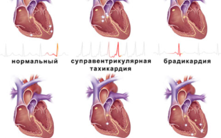 Признаки и симптомы проблем с сердцем