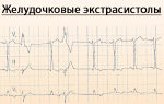 Все о классификации желудочковых экстрасистол по Лауну