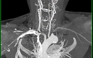Ангиография сосудов шеи (кт, рт): брахиоцефальных, интракраниальных, соннных и позвоночных артерий