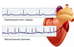 Что делать при приступе аритмии сердца – как его быстро снять