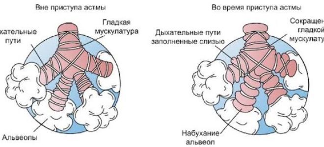 Кашлевая форма бронхиальной астмы: причины, симптомы, лечение