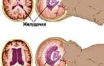 Внутричерепная гипертензия: симптомы у взрослых, косвенные признаки и лечение