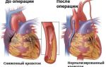 Операция при пороке сердца: стоимость, техника и показания