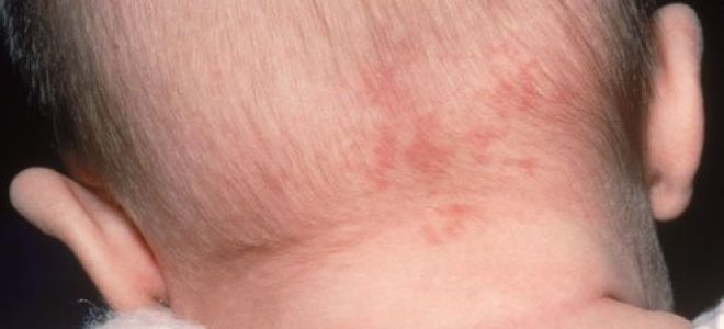 Удаление гемангиомы: лазером, скальпелем, криотерапией, электрофорезом, склеротерапией