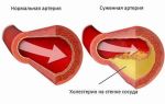 Красный рис от холестерина: как принимать при повышенных покахателях холестерола в крови