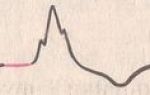 Расшифровка кардиограммы сердца с синусовым ритмом