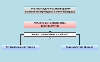 Что такое аритмия или желудочковая тахикардия типа пируэт