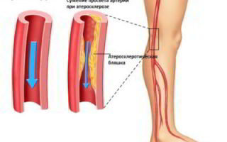 Атеросклероз почечных артерий: причины, симптомы, код по мкб 10