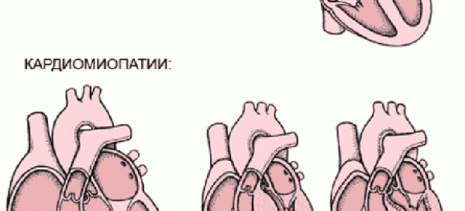Острые или тянущие боли в сердце после приема алкоголя: борьба с похмельем