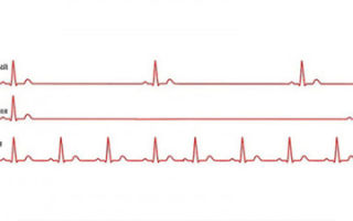 Что такое брадикардия: ее причины, симптомы, лечение