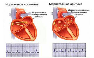 Экстрасистолия