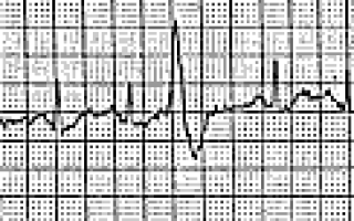 Пароксизмальная тахикардия: симптомы, лечение, советы врача
