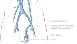 Операция мармара при варикоцеле: показания и противопоказания, преимущества и недостатки, техника проведения, осложнения, стоимость