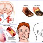 Гирудотерапия при варикозе: отзывы, польза и вред лечение варикоза пиявками, фото до и после