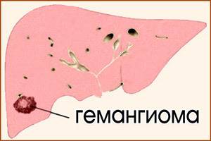 Кавернозная гемангиома (печени, позвоночника, кожи): симптомы, лечение (нейрохирургия)