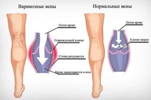 Внутренний варикоз на ногах (скрытый): симптомы и лечение