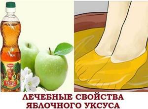 Яблочный уксус при варикозе на ногах: как пользоваться, отзывы, рецепты