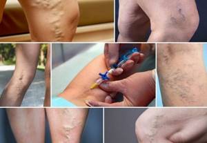 Уколы от варикоза вен на ногах: склеротерапия, Трентал, Фибро-Вейн, инъекции гепарина