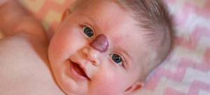 Капиллярная гемангиома у взрослых и новорожденных детей: фото, лечение, виды