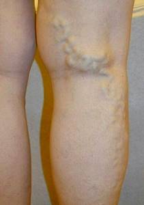 Боли в ногах при варикозе: симптомы (как болит), почему и как обезбаливать