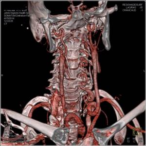 Ангиография сосудов шеи (КТ, РТ): брахиоцефальных, интракраниальных, соннных и позвоночных артерий
