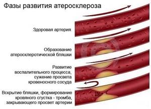 Атеросклероз сосудов верхних конечностей: симптомы и лечение