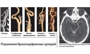 Ангиография сосудов шеи (КТ, РТ): брахиоцефальных, интракраниальных, соннных и позвоночных артерий