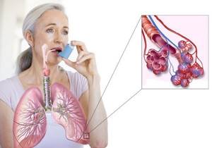 Обострение астмы: виды и степени тяжести, причины, симптомы, лечение