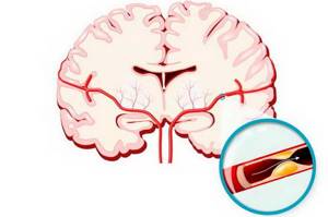Атеросклероз магистральных сосудов головного мозга: симптомы и лечение