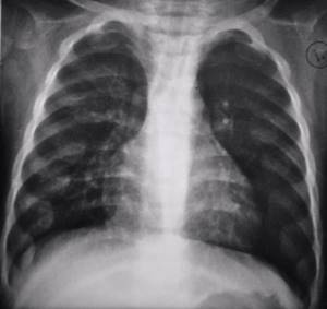 Фенотипы бронхиальной астмы: их виды, характеристики и особенности лечения