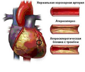Атеросклероз коронарных артерий: симптомы, лечение, код по МКБ 10