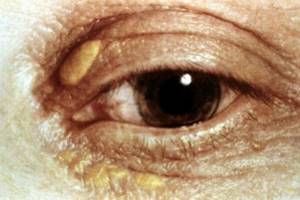 Ксантомы (ксантелазмы) на веках: что это такое, лечение холестериновых бляшек глаз