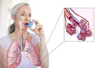 Профессиональная астма: причины, симптомы, лечение и профилактика
