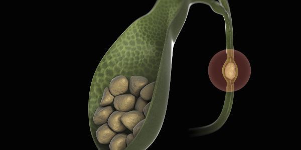 Холестериновые камни в желчном пузыре: лечение, симптомы и причины образования