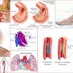 Стенозирующий атеросклероз: сонных артерий, нижних конечностей, коронарных артерий