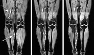 МРТ сосудов нижних конечностей: что показывает и как проводится диагностика вен и артерий ног