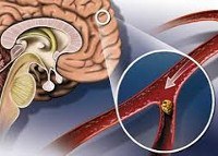 Атеросклероз сосудов головного мозга: симптомы и лечение, код по МКБ 10