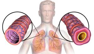 Бронхиальная астма в стадии ремиссии: терапия, реабилитация, рекомендации
