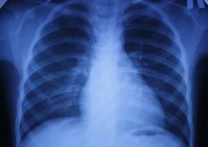 Рентген при бронхиальной астме: виды исследования и результаты
