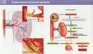 Атеросклероз почечных артерий: причины, симптомы, код по МКБ 10