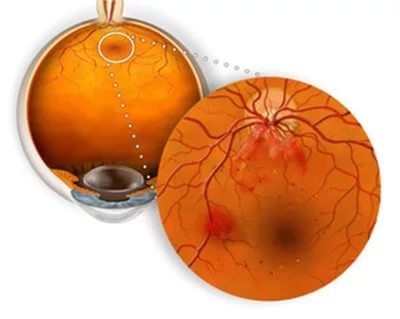 Атеросклероз сетчатки глаза: что это, лечение и профилактика