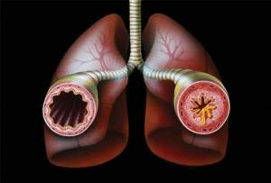 Как жить с астмой: контроль заболевания, лечение, образ жизни
