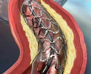 Стентирование сосудов сердца: сколько живут после операции, отзывы и реабилитация