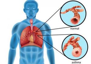 Кашлевая форма бронхиальной астмы: причины, симптомы, лечение