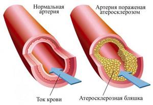 Атеросклероз брюшной аорты: что это такое, как лечить, симптомы