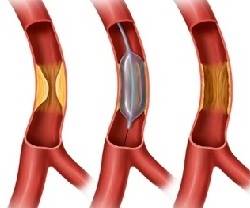 Баллонная ангиопластика сосудов сердца (коронанарная) и нижних конечностей — что это такое