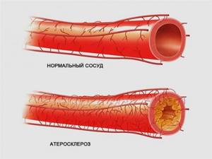 Атеросклероз сосудов нижних конечностей: симптомы и лечение, код по МКБ 10