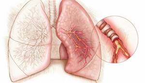 Чем отличается астма от бронхита: симптомы, диагностика, лечение